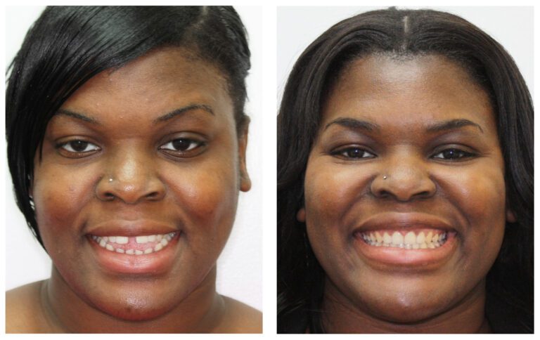 Patient Smile Transformations