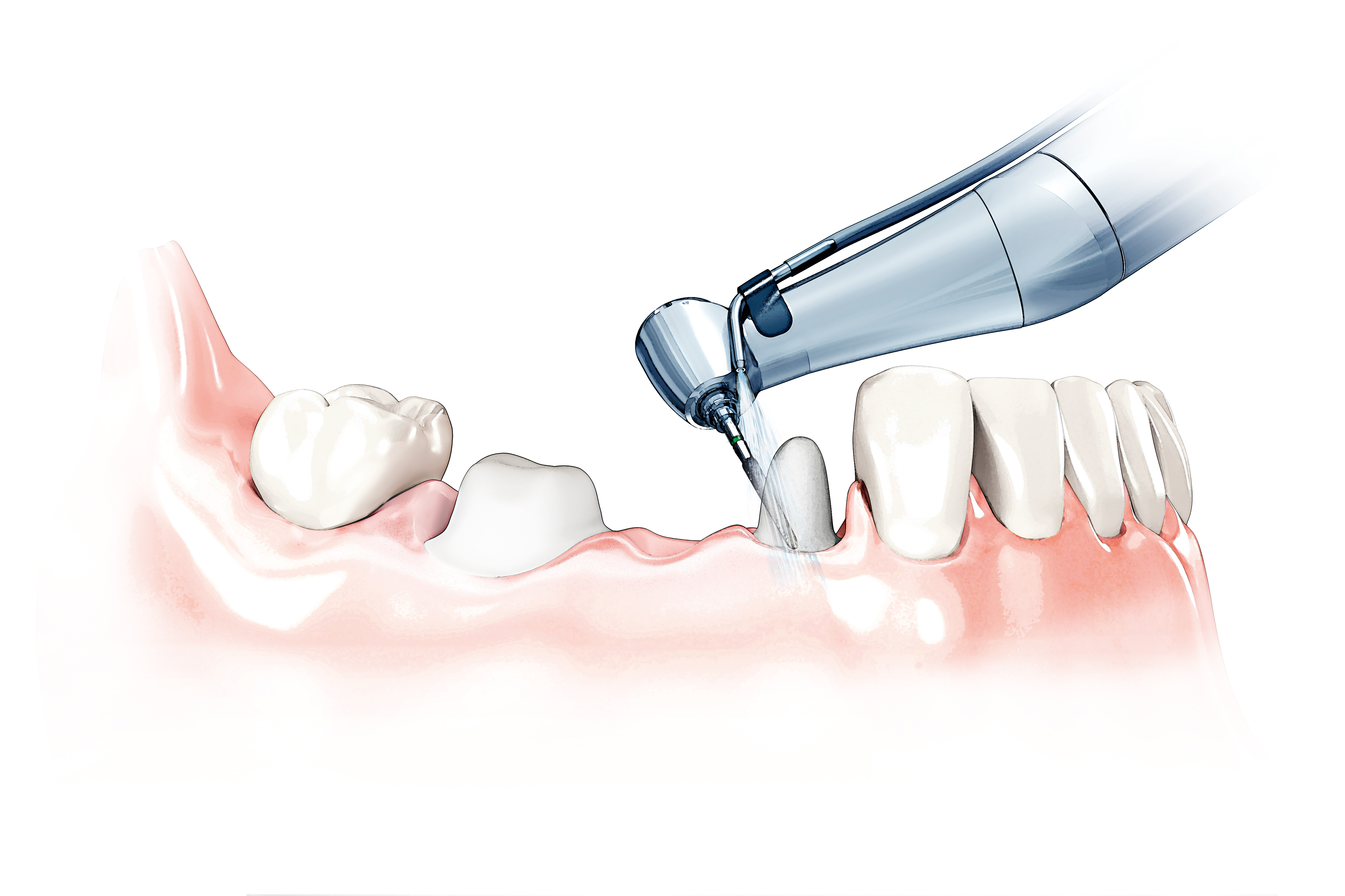 implant supported bridge