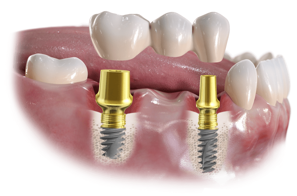 implant supported bridge
