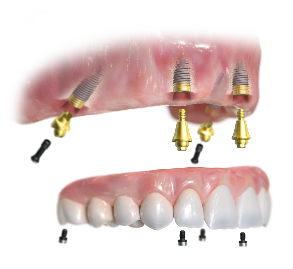 Full Arch or Full Mouth Dental Implants