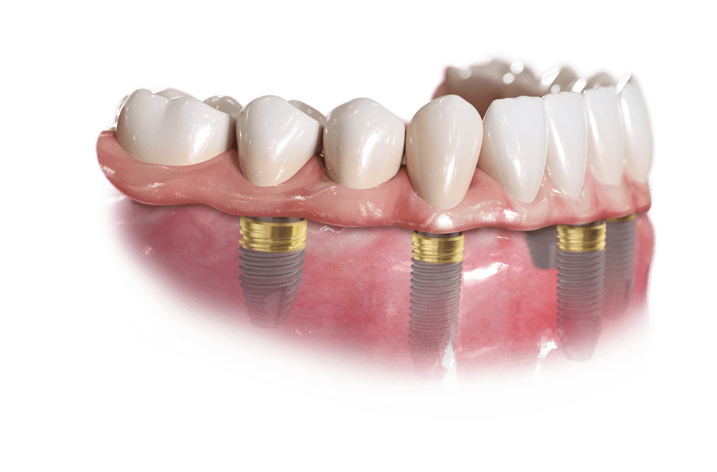 Same Day Teeth / Dental Implant - Full Arch