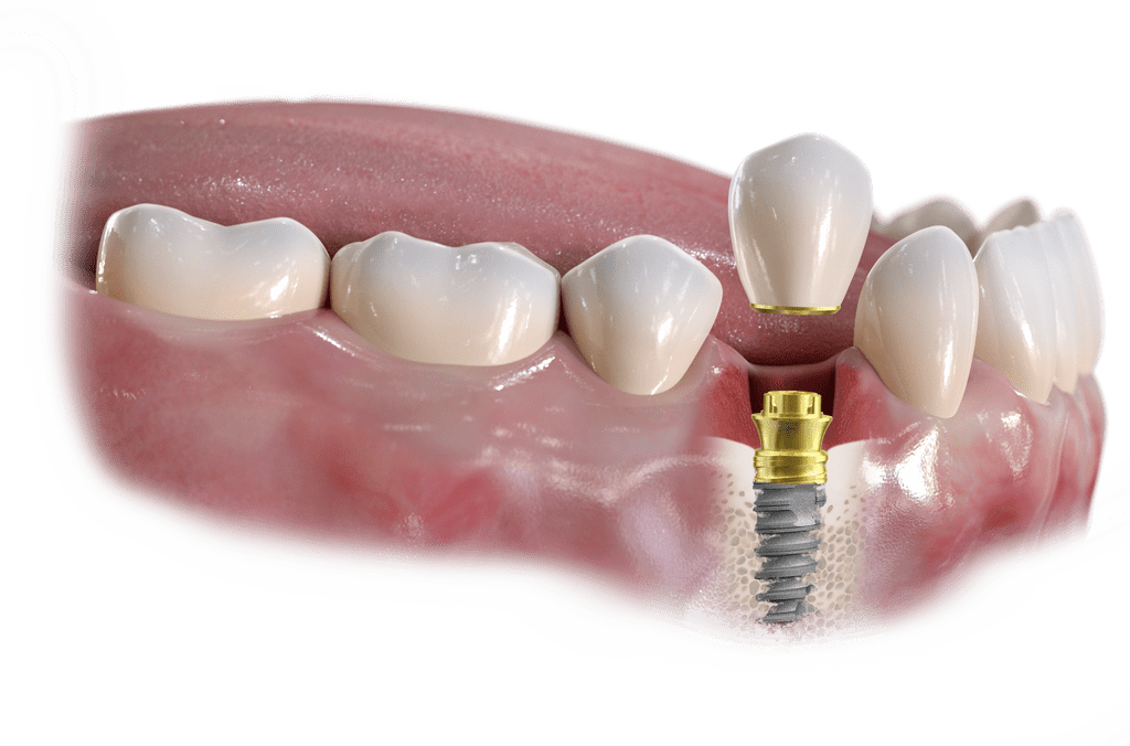 Single Tooth Dental Implants