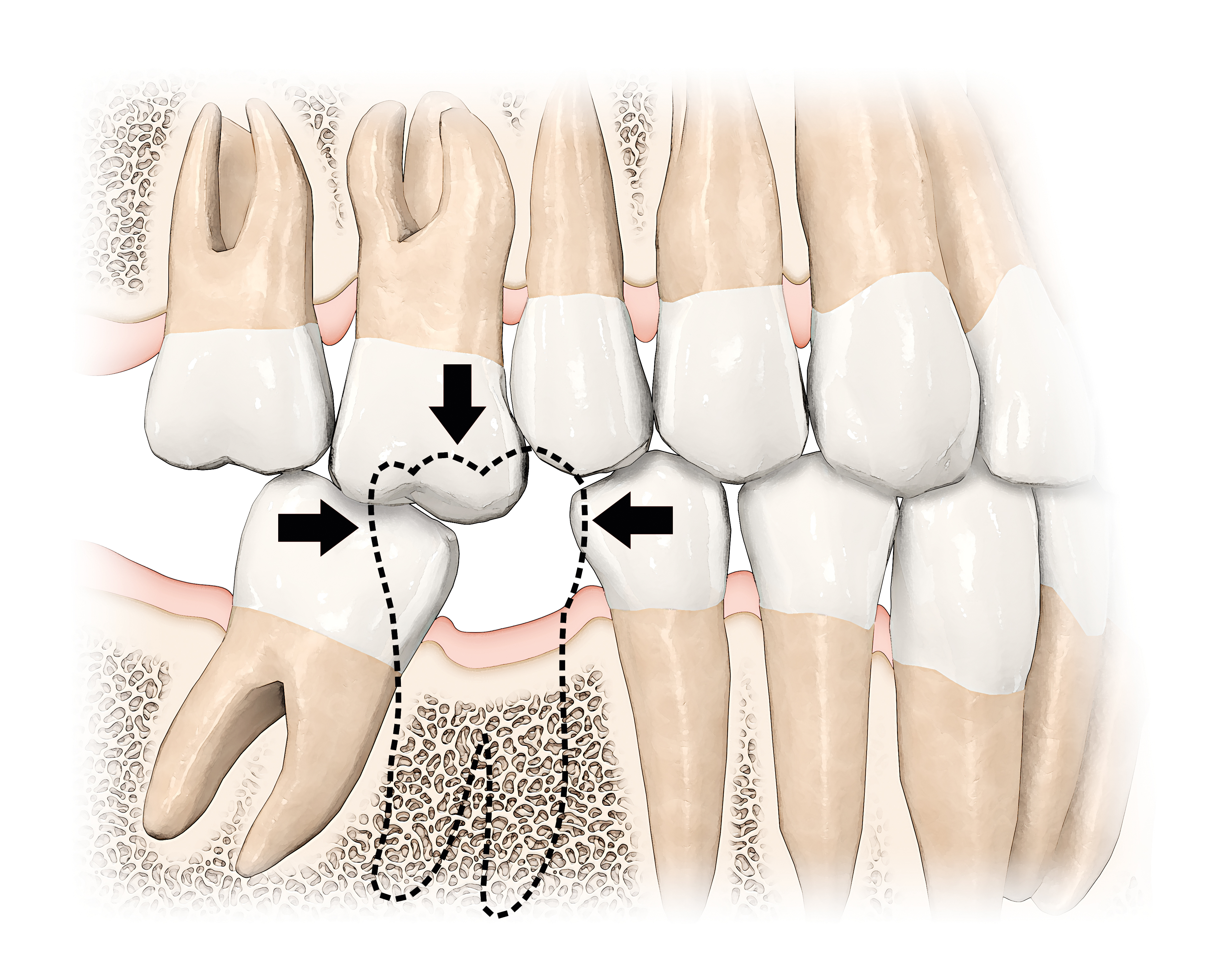 Single Tooth Dental Implants